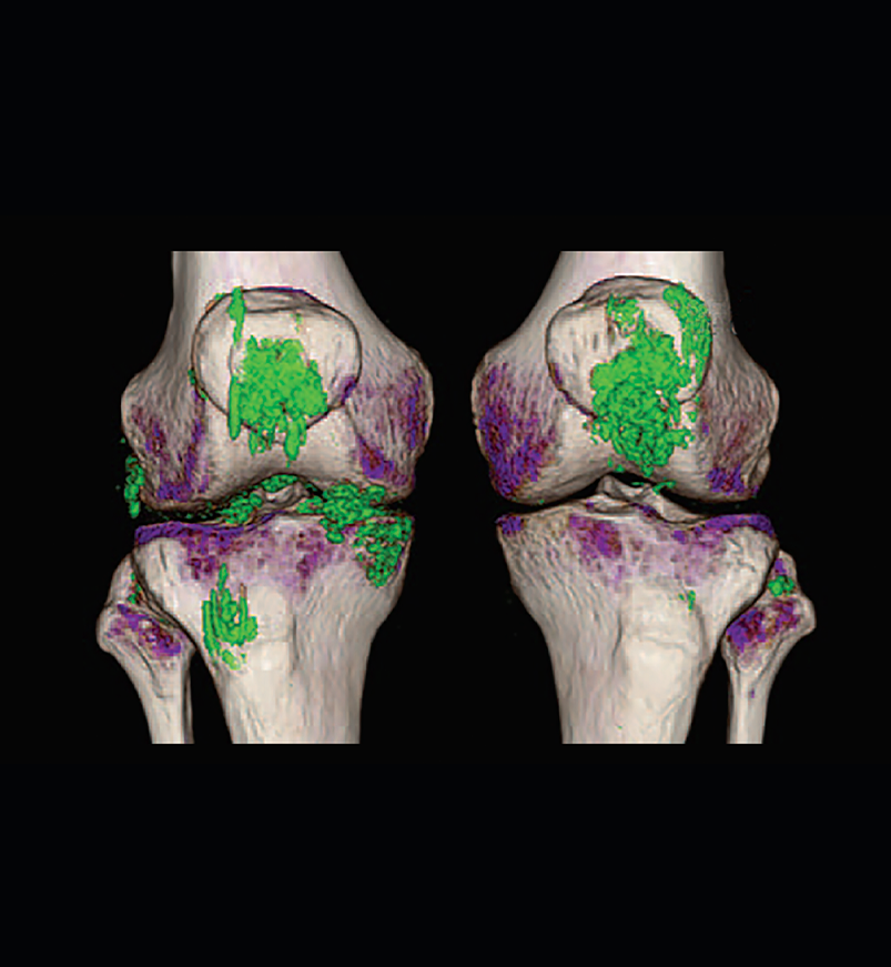 Dual energy computed tomography scan showing uric acid deposition in knee joints